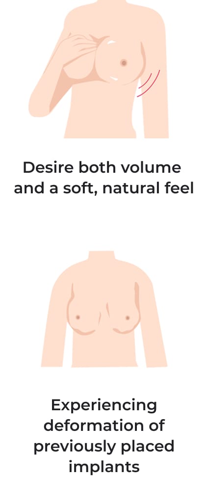 Desire both volume and a soft natural feel, experiencing deformation of previously placed implants