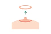 Areola Reduction