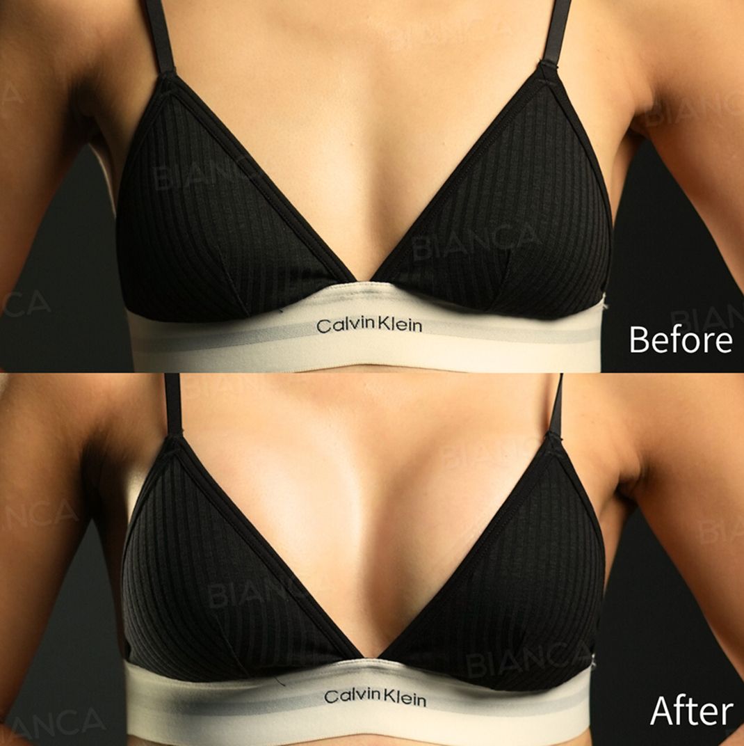 Preservé breast augmentation