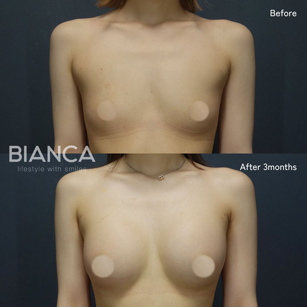 Fat grafting breast augmentation