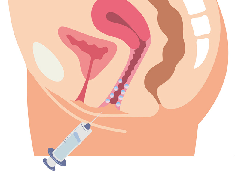 What is Vaginal Hyaluronic Acid Injection?