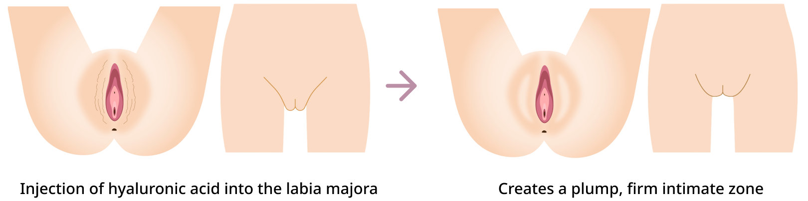 Procedure Method