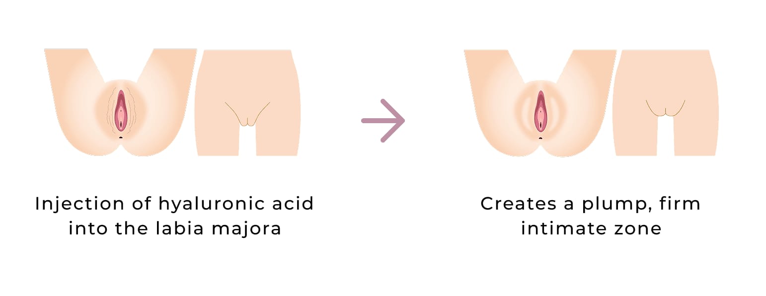 Procedure Method