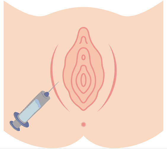 What is Labia Majora Hyaluronic Acid Injection?