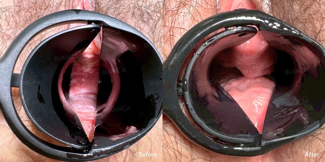 Vaginal hyaluronic acid injection case photo
