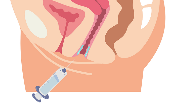What is Vaginal Rejuvenation Injection?