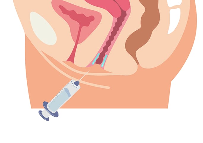 What is Vaginal Rejuvenation Injection?