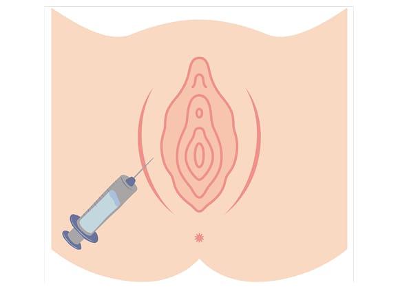 What is Botox for Dyspareunia?