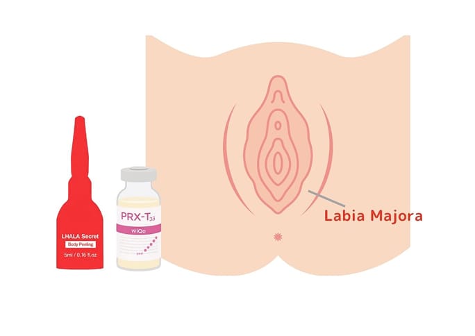 What is Intimate Area Chemical Peel?