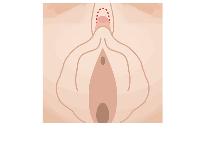 What is Clitoral Hood Reduction?