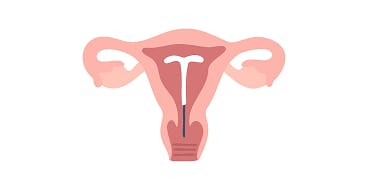 Those who are hesitant about having a device placed inside the uterus