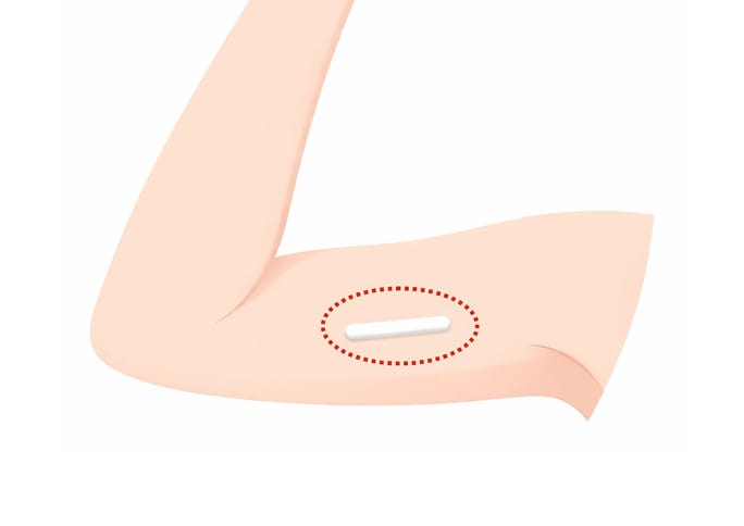 What is Contraceptive Implant?