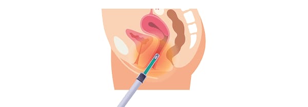 Treatment step: Ultra-fine needle applicator is inserted into vagina and external genital area