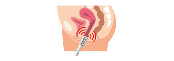 Treatment step: Intravaginal applicator is inserted and EMS induces repeated pelvic floor muscle contractions for several minutes