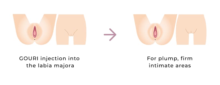 GOURI injection into the labia majora and plump, firm intimate areas