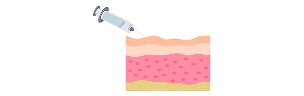 Treatment step: Using topical or local anesthesia, GOURI is evenly injected into the labia majora using cannula or fine needles.
