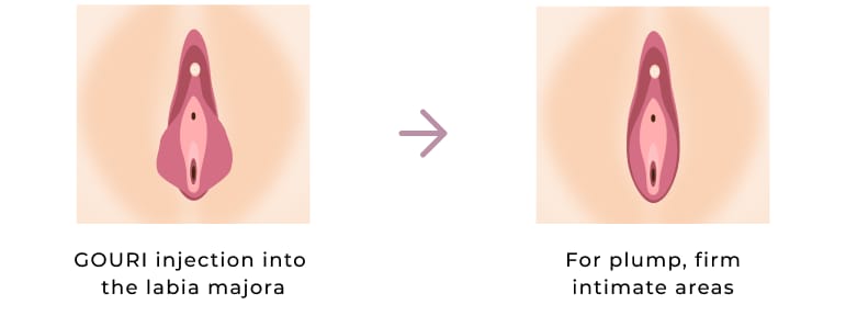 GOURI injection into the labia majora and plump, firm intimate areas