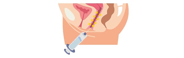 Treatment step: GOURI is injected in multiple fine points throughout the vaginal walls.