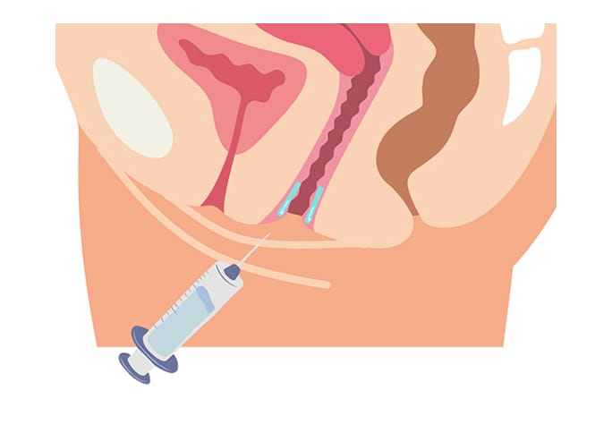 What is Vaginal GOURI?