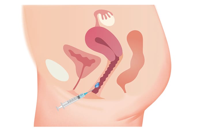 What is G-Shot Injection?