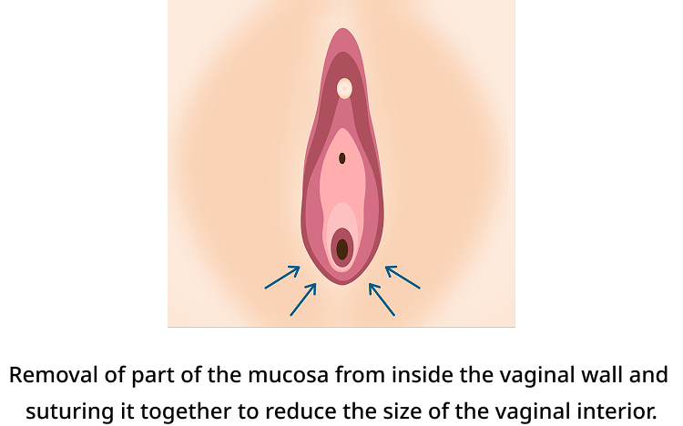 Procedure Method