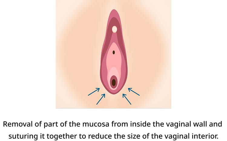 Procedure Method