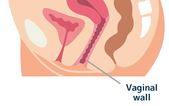 What is Hood Removal?