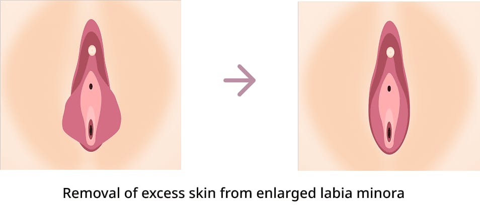 Procedure Method