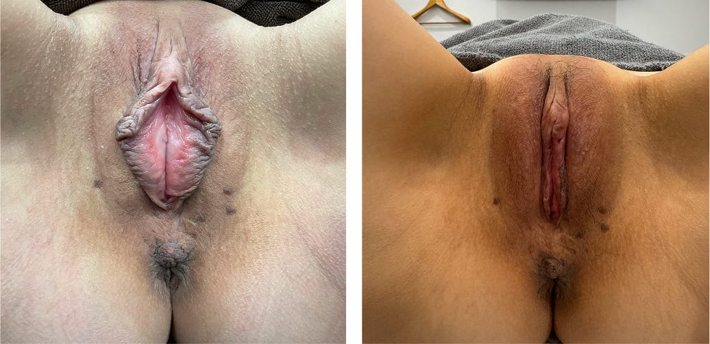 Labia minora reduction, clitoral hood excision, and labia majora hyaluronic acid injection case photo
