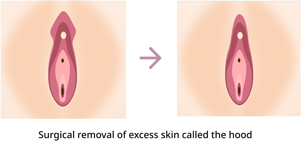 Procedure Method