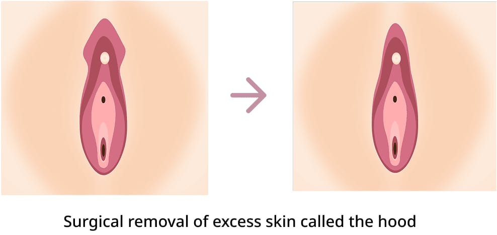 Procedure Method