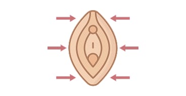 Noticing a loss of volume in the labia majora