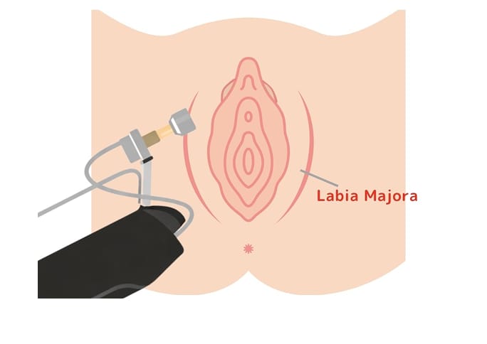 What is TriFill Pro for Intimate Area?