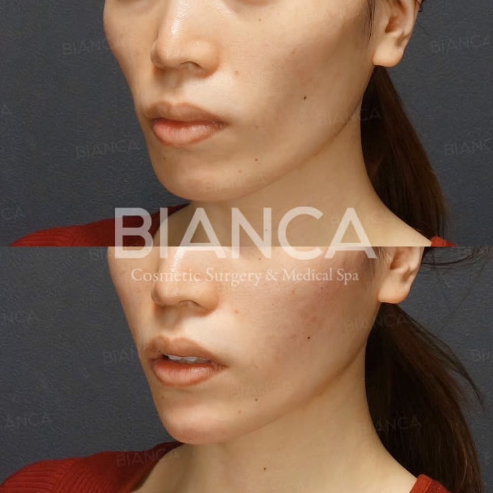 Before and immediately after comparison of cheek filler treatment, oblique angle