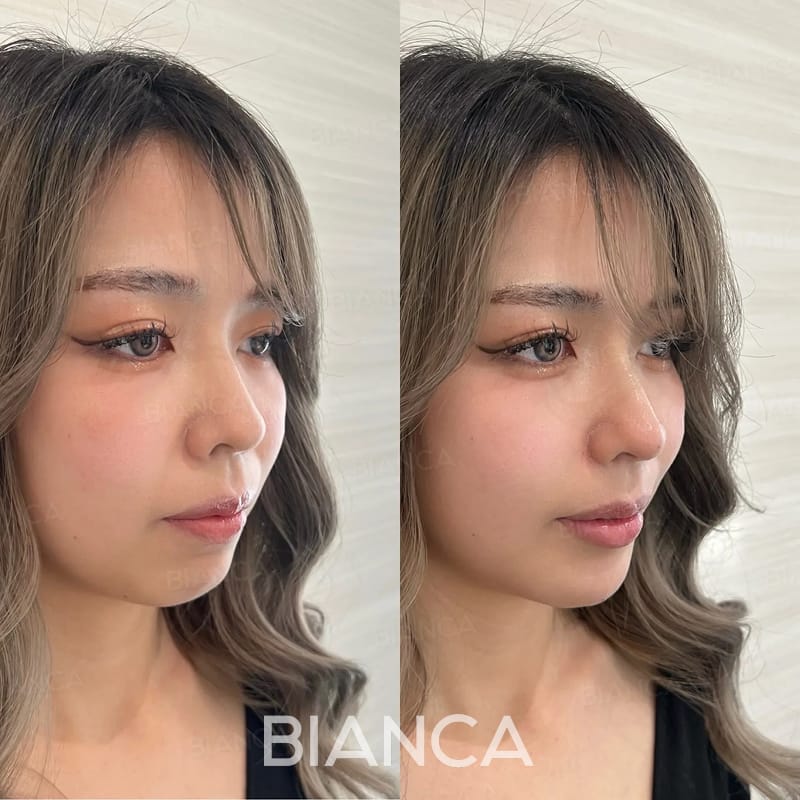 Before and immediately after comparison of customized filler treatment, profile angle
