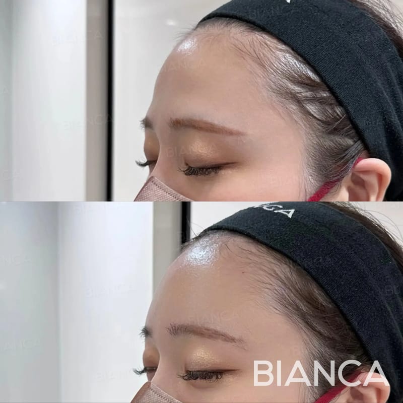 Before and immediately after comparison of forehead filler treatment, profile angle