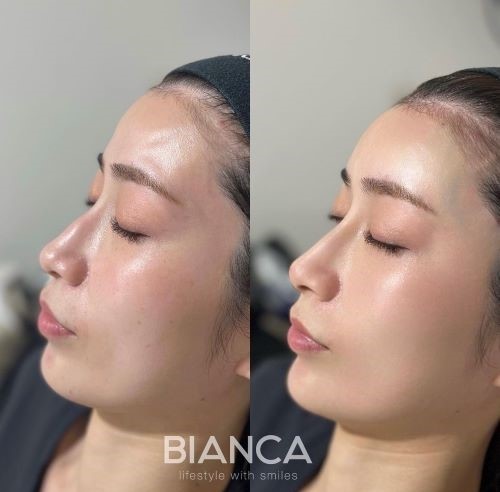 Filler / Hyaluronic acid injection