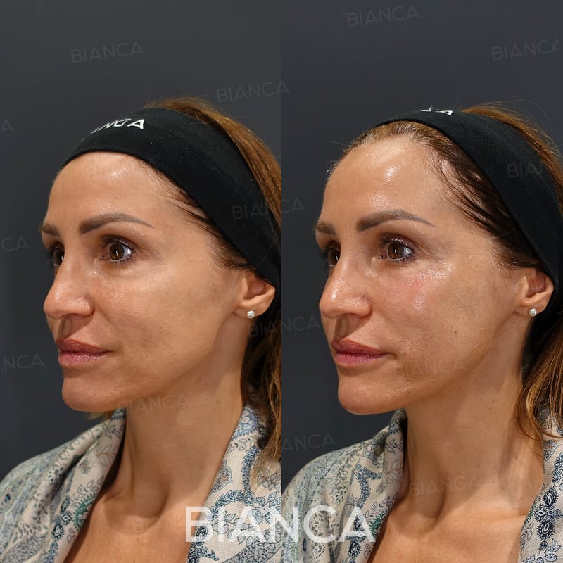 Before and immediately after comparison of lift-up filler treatment, oblique angle