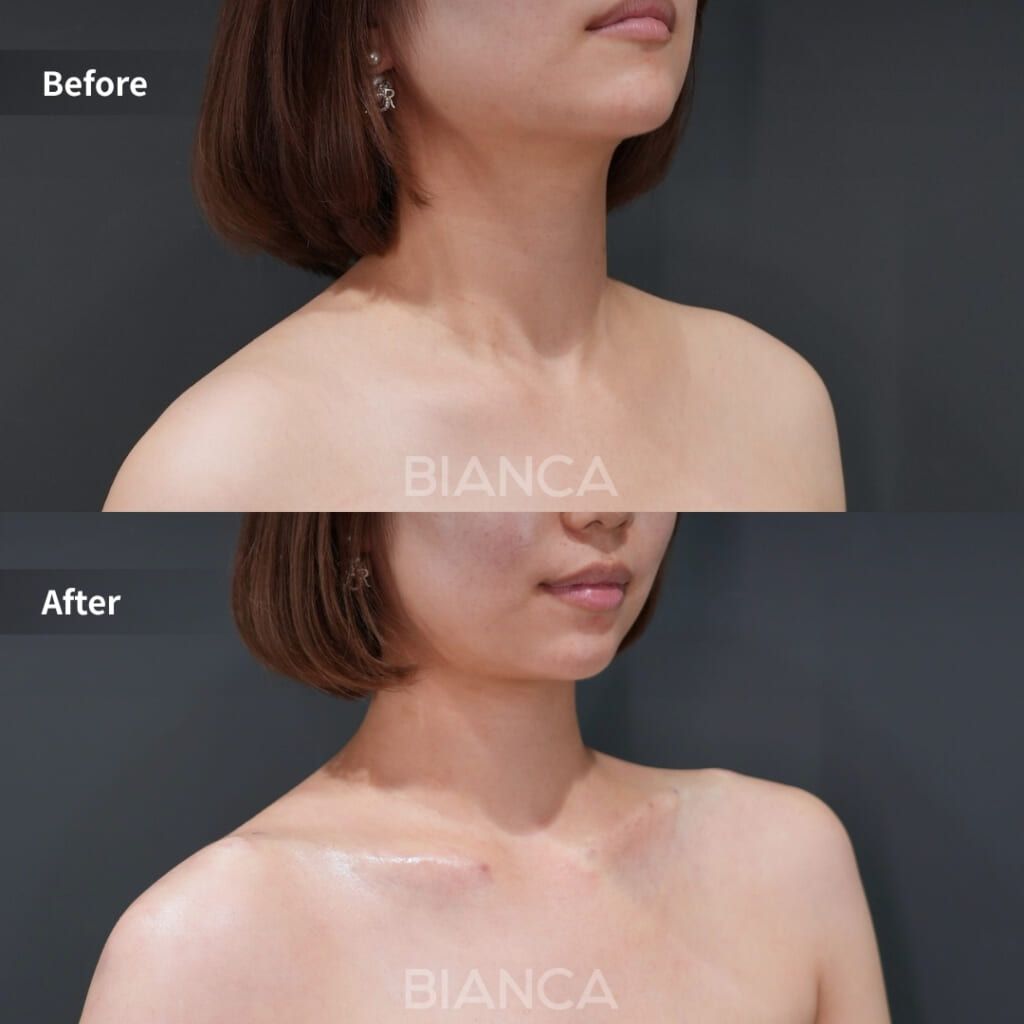 Before and immediately after comparison of décolletage filler treatment
