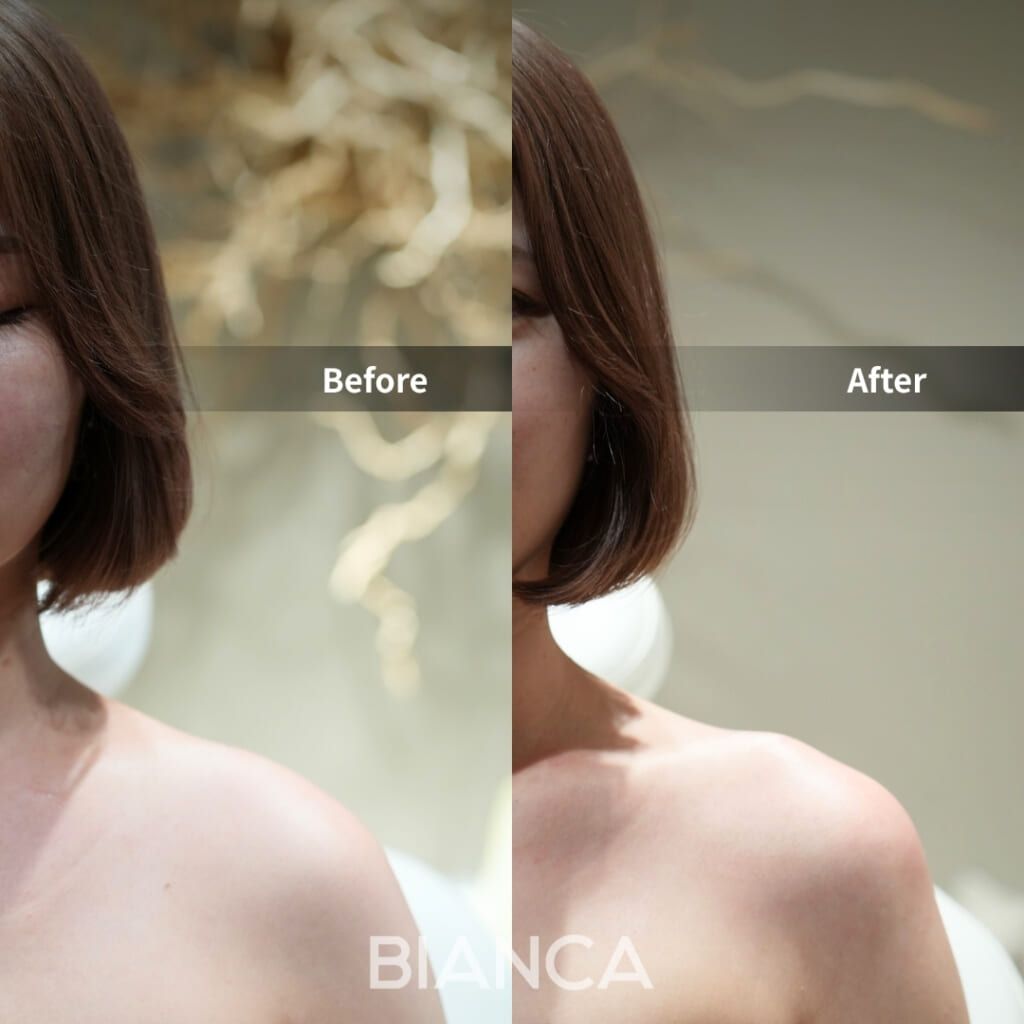 Before and immediately after comparison of shoulder filler treatment