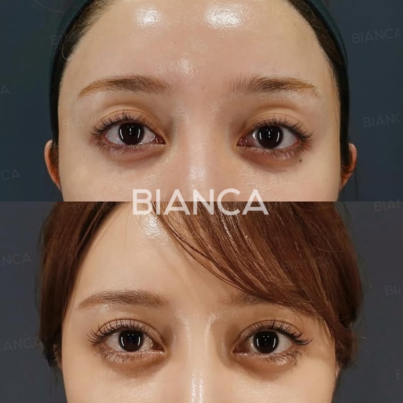 Before and immediately after comparison of upper eyelid filler treatment, front view