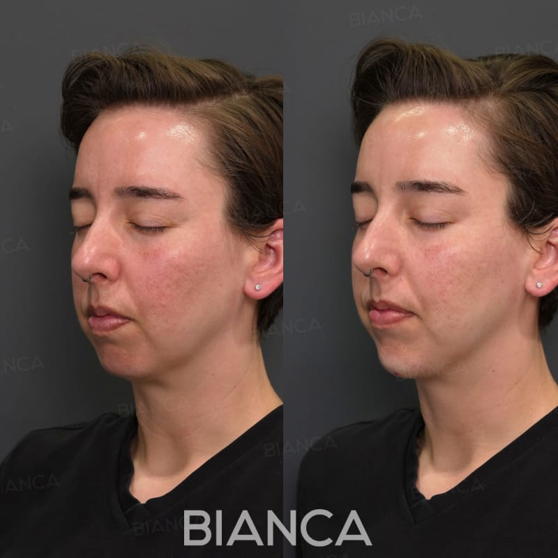Before and immediately after comparison of chin filler treatment, profile angle
