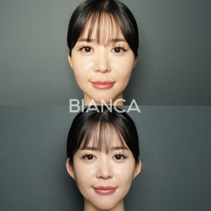 Before and immediately after comparison of ear filler treatment, front view