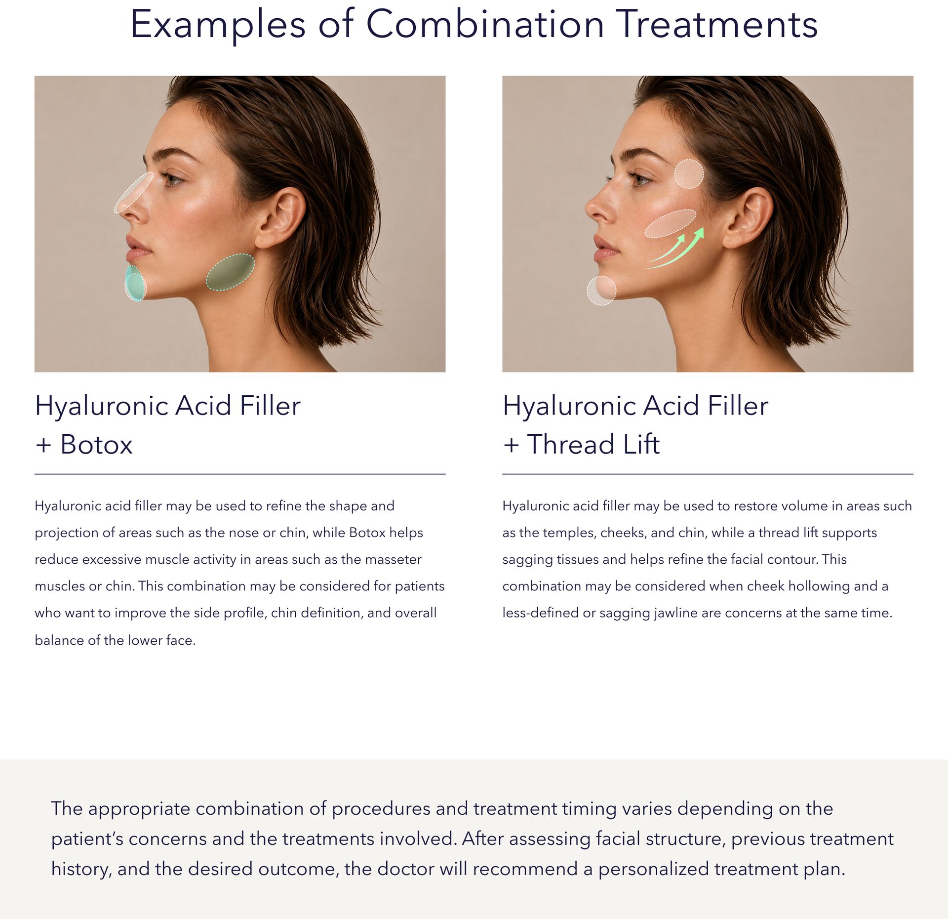 Combination treatment diagrams: filler-Botox and filler-thread lift for facial contouring