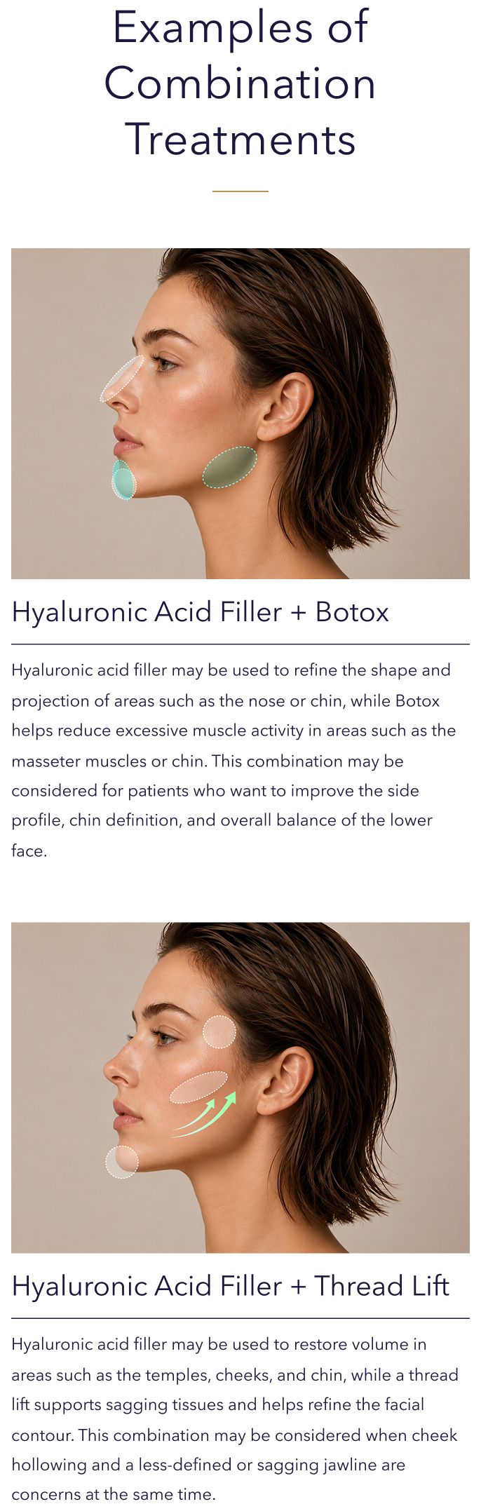 Combination treatment diagrams: filler-Botox and filler-thread lift for facial contouring