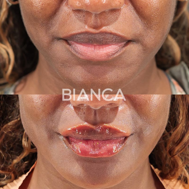 Before and immediately after comparison of lip filler treatment, front view