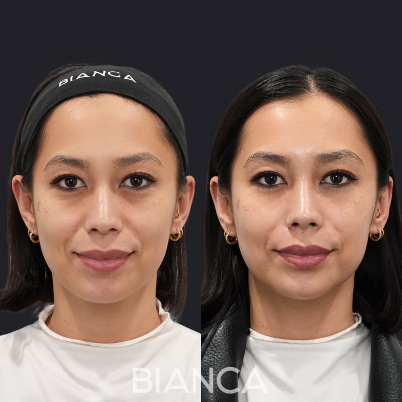 Before and immediately after comparison of nasolabial fold filler treatment, front view