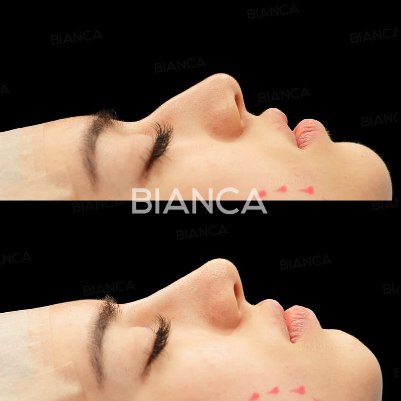 Before and immediately after comparison of nose filler treatment, profile angle
