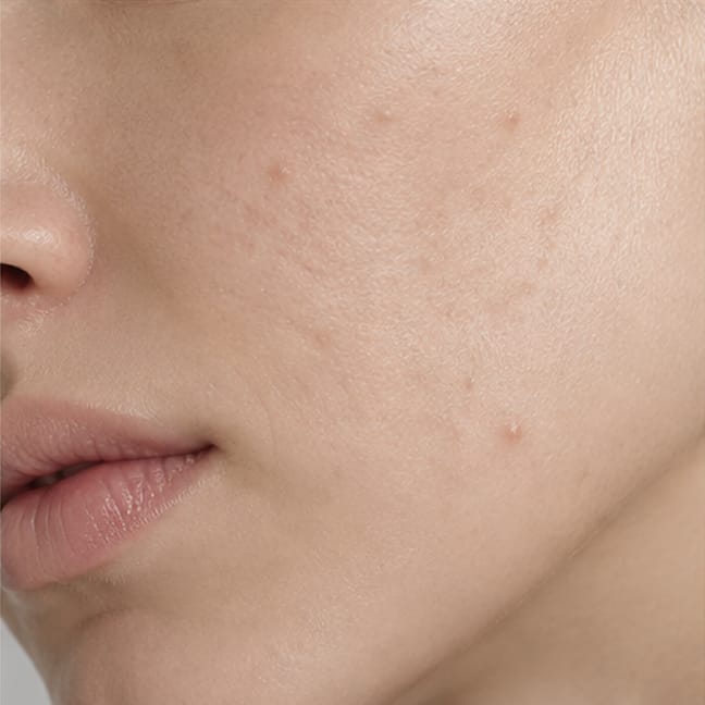 Close-up of a woman's cheek with post-acne marks