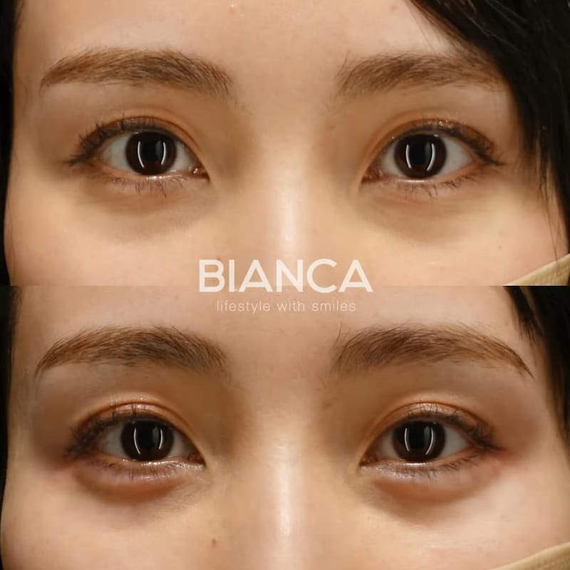 Before and immediately after comparison of tear trough filler treatment, front view